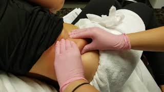 Post-CoolSculpting Massage at Mystique Medical Spa in Fresno, California
