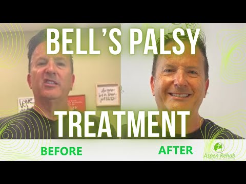 Aspen Rehab Physical Therapy in Coral Springs – Bells Palsy