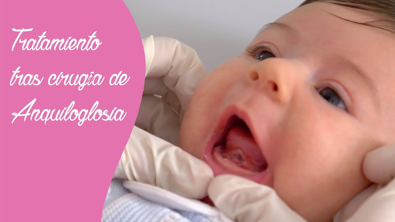 Watch Tratamiento tras la cirugía de anquiloglosia o frenectomía lingual. 👅👶🏼 Now Tratamiento tras la cirugía de anquiloglosia o frenectomía lingual. 👅👶🏼