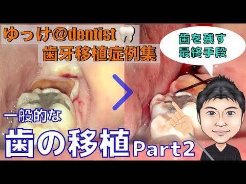 生命歯学科 【治療症例集】保険でできる親知らずを利用した歯の移植法を公開！インプラント、ブリッジ、入れ歯に次ぐ第4の治療法「歯の移植」をわかりやすく解説！抜歯宣告された歯を抜いてしまうその前にぜひご覧ください！