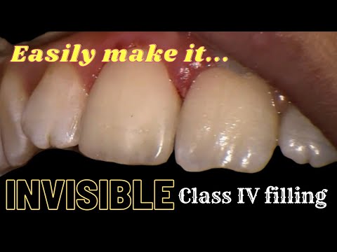 Invisible Class IV Composite Restoration | Step-by-Step Procedure