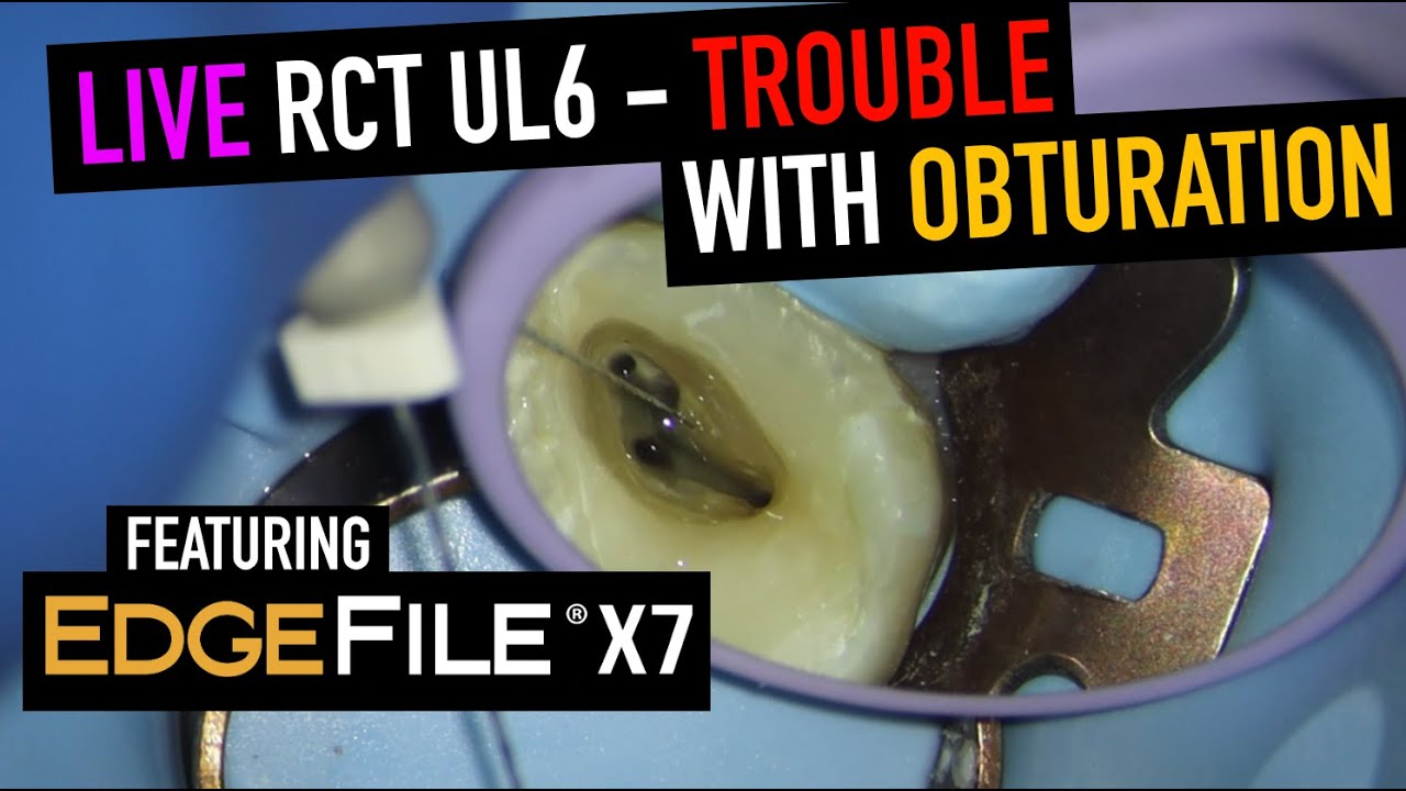 EdgeFile X7 Review During Root Canal on UL6 – Is This File Too Aggressive?