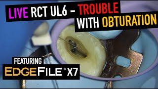 EdgeFile X7 Review During Root Canal on UL6 – Is This File Too Aggressive