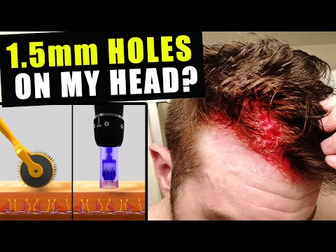 I Cut Thousands Of 1.5 Millimetre Holes In My Head...