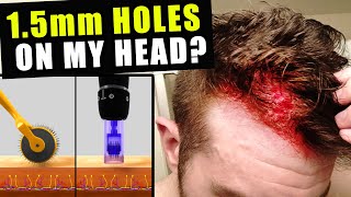 I Cut Thousands Of 1.5 Millimetre Holes In My Head Every Week To Prevent Hair Loss