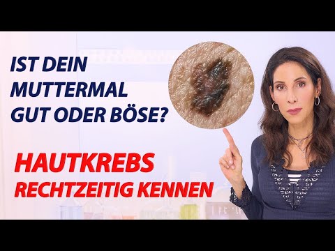 How to recognize melanoma – these 5 signs you need to know! | Doctor Julie