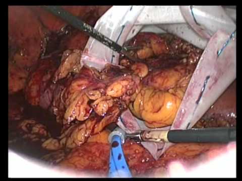 Renal Cell Cancer - Laparoscopic Partial Nephrectomy 