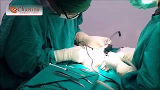 เลาะซิลิโคนเหลวที่ร่องแก้มผ่านช่องปาก