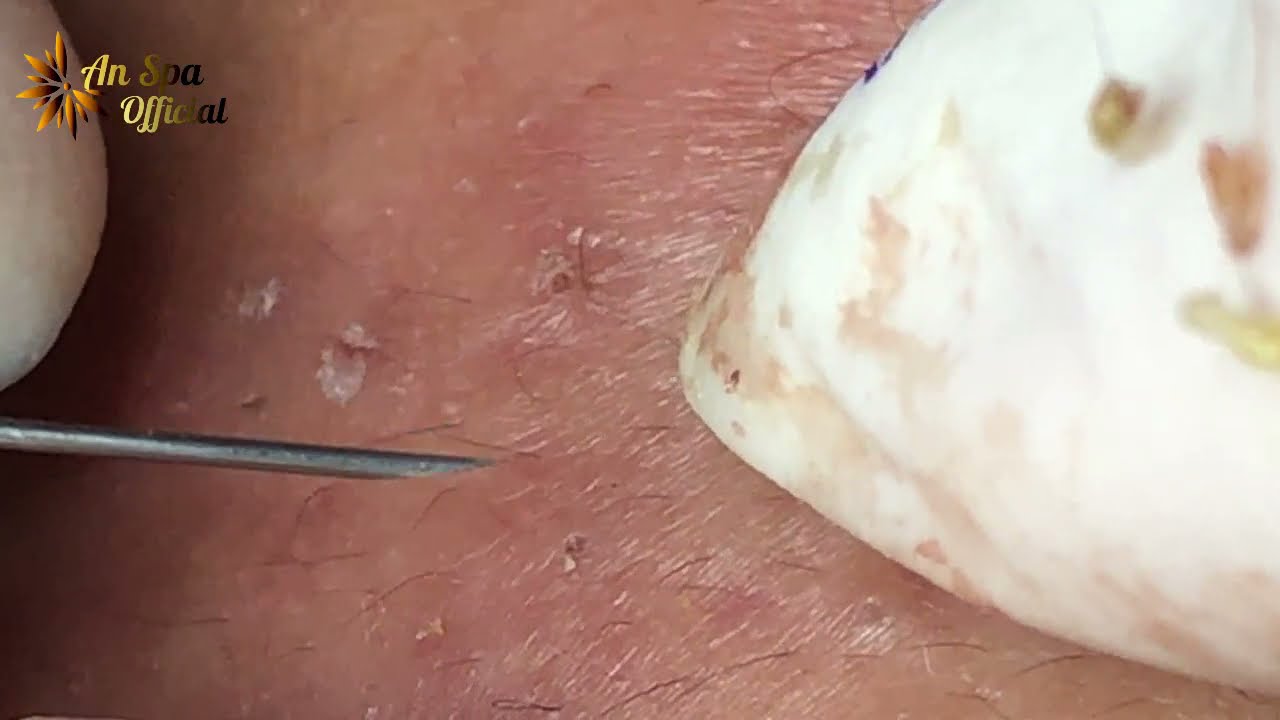 외국 피지 제거 영상  썸네일