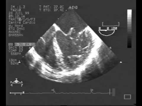 Infective Endocarditis