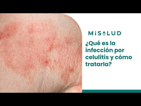 Celulitis