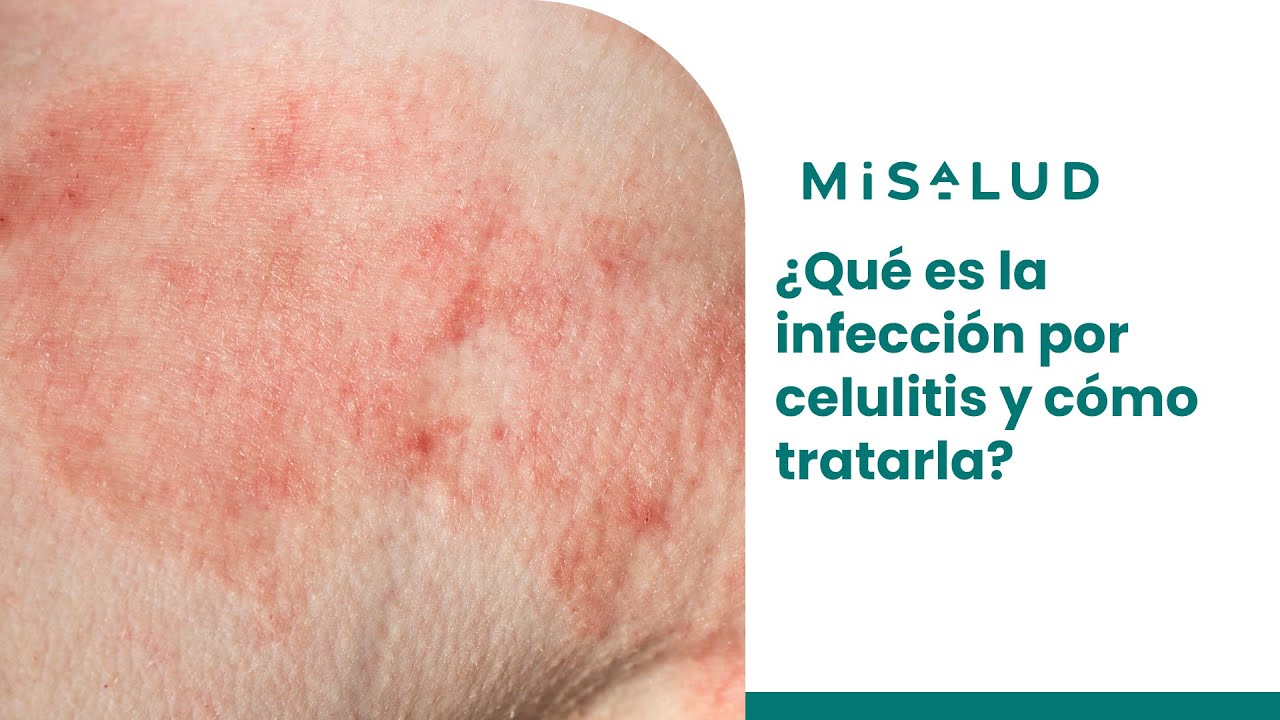 ¿Qué es la infección por celulitis y cómo tratarla | MiSalud