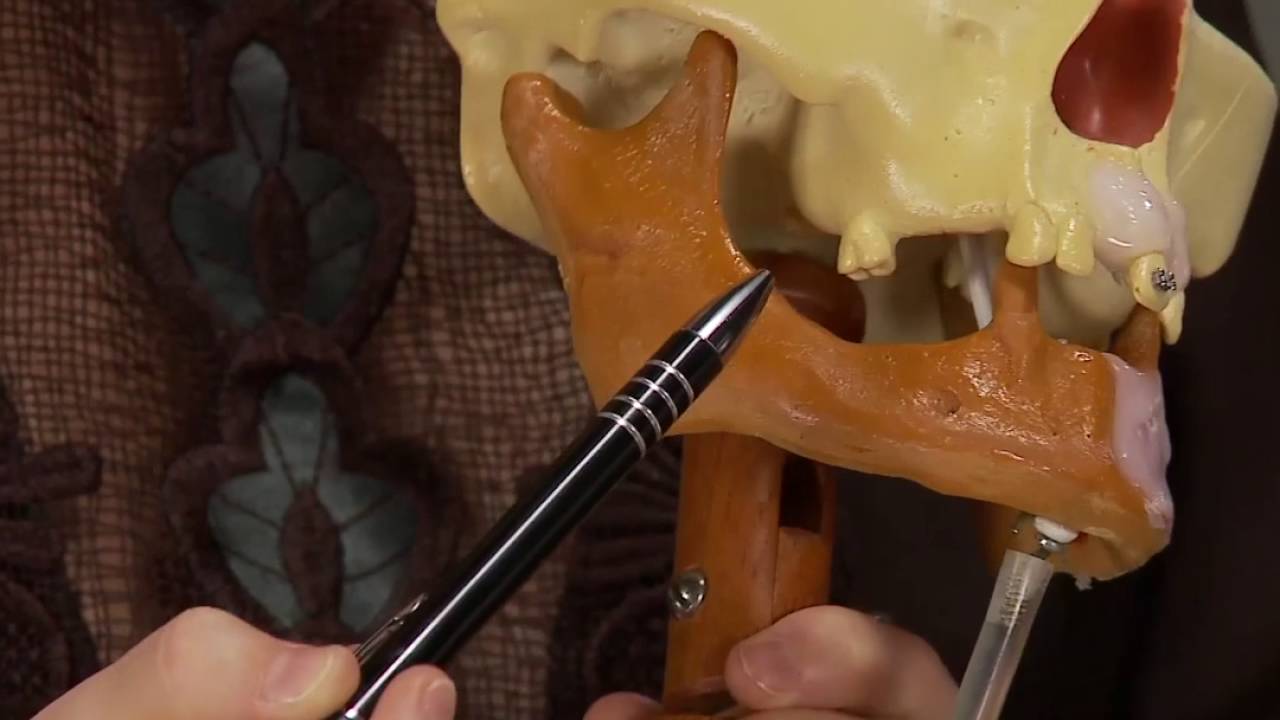 Enxerto osseo de seio maxilar com Bio Oss