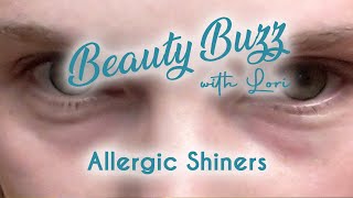 Beauty Buzz with Lori: Allergic Shiners