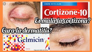 Puedo usar cortizona es dañina tengo dermatitis / ezcema / alergias en la piel