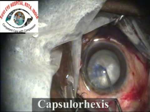 Small Incision Cataract Surgery By Fishhook Technique