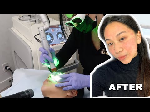 Tattoo Removal Machine