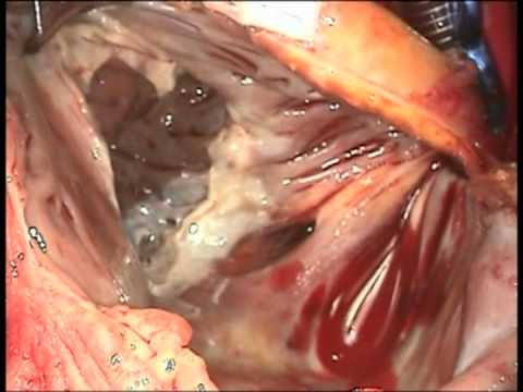 Tricuspid Valve Replacement for Endocarditis