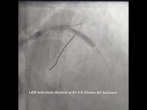 Culotte Technique for LM bifurcation