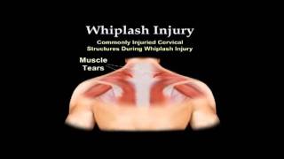 preview picture of video 'Whiplash Neck and back Pain Advice for Accident Team Gravesend'