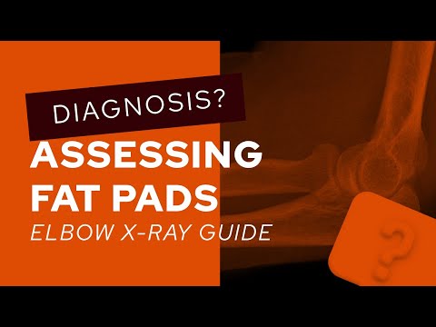 Elbow X-Ray guide: how to assess fat pads