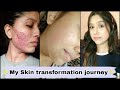 My Skin Transformation Journey Cystic Acne Red Scar Shorts