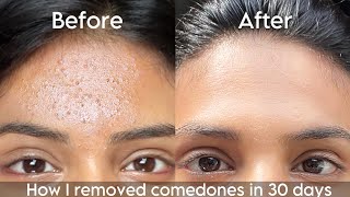 How I removed tiny white bumps from my forehead in 30 days | How to get rid of closed comedones