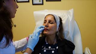 Botox Treatment around the Mouth, cosmetic procedure by Dr. Jafari