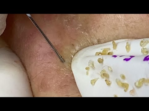 Loan Nguyen Acne Treatment (#104)