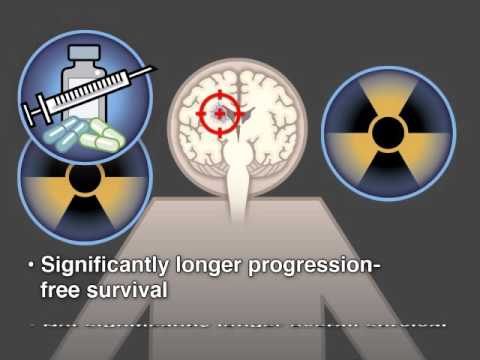 Treatment of Low-Grade Glioma