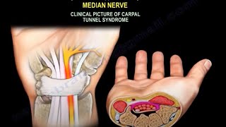 Carpal Tunnel Syndrome - Everything You Need To Kn