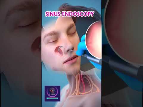 Sinus Endoscopy Procedure | Nasal Endoscopy for Diagnosis & Treatment