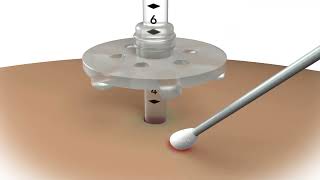 Product video: MIC (G Tube) Gastrostomy Feeding Tube