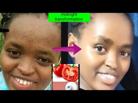 Tomato + colgate to remove pimples //  how to remove blackspots and acne / how to smoothen your skin