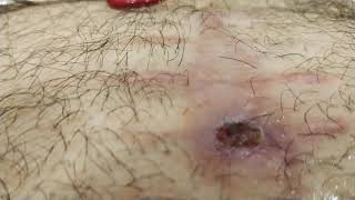 Como extraer un punto de sutura tu mismo, cuando no te los quitan. XD