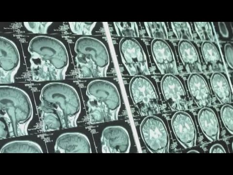 Understanding aphasia and its recovery process