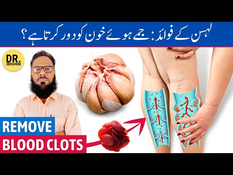 Lahsun Ke Fayde - Remove Blood Clots in Legs - Garlic Benefits - Urdu/Hindi - Dr. Ibrahim