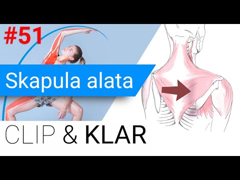 Skapula alata erklärt - Engelsflügel ohne "Bodenhaftung"