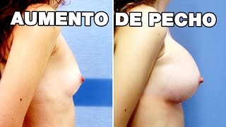 Aumento de pecho | Testimonios Clínicas Diego de León Madrid