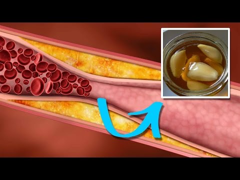 Diabetes bei jungen Mädchen Anwendung von Leinsamen Diabetes
