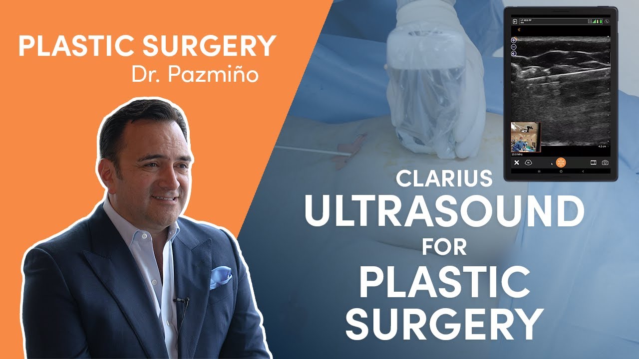 Five Reasons Dr. Pazmiño Prefers Clarius Ultrasound for Plastic Surgery