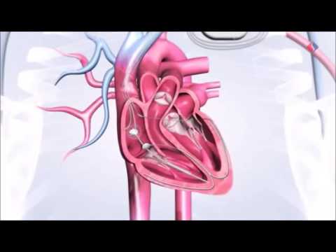 Einsetzen eines Resynchronisationssystems Ausschnitt aus Volle Leistung für das Herz Teil 6