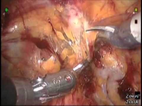 Robotic Radical Prostatectomy - STEP 3-  Retzius Space Dissection