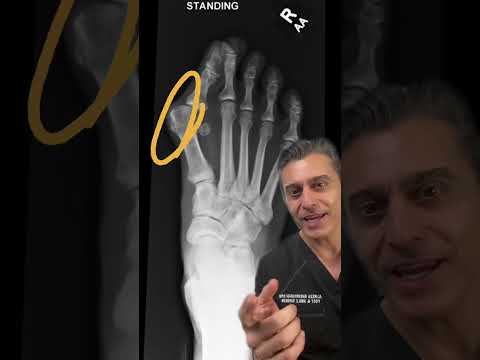 How to Fix Bunions NATURALLY?!