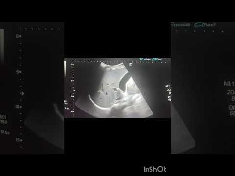 Ultrasound liver and gallbladder! Ultrasound abdomen!#ultrasoundmadeeasy86#radiology