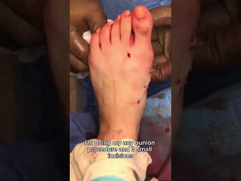 How to Fix Bunions in 30 Seconds