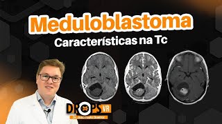 CARACTERÍSTICAS TÍPICAS DO MEDULOBLASTOMA NA TC I VOCÊ RADIOLOGISTA