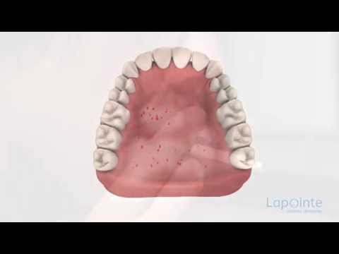 comment guerir du purpura
