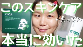 【マスク荒れ】肌荒れを救ったスキンケア【敏感肌&乾燥肌に本当に効いた韓国コスメ】
