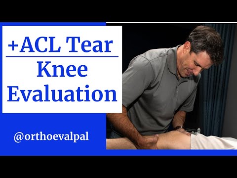Modified Lachman s Test On a patient with a COMPLETE ACL TEAR